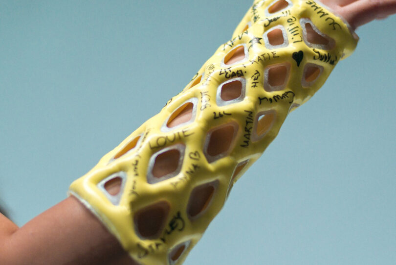 Yellow Cast21 orthopedic sleeve connected patient's limb pinch get good signatures crossed it.