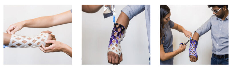 Three step-by-step photos of nan exertion of nan Cast21 orthopedic sleeve onto a patient's arm.